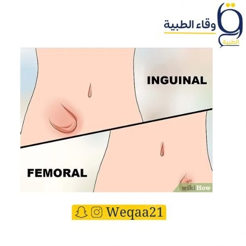 حزام الفتق للبطن