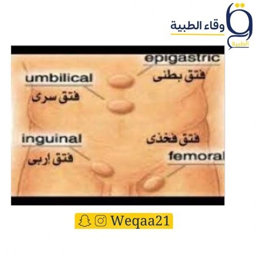 حزام الفتق للكبار