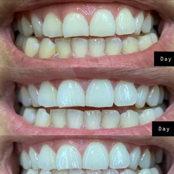  كريست 3D Whitestrips™m,مجموعة تبييض الأسنان، للحصول على اسنان ناصعة البياض، 20 شريطًا 