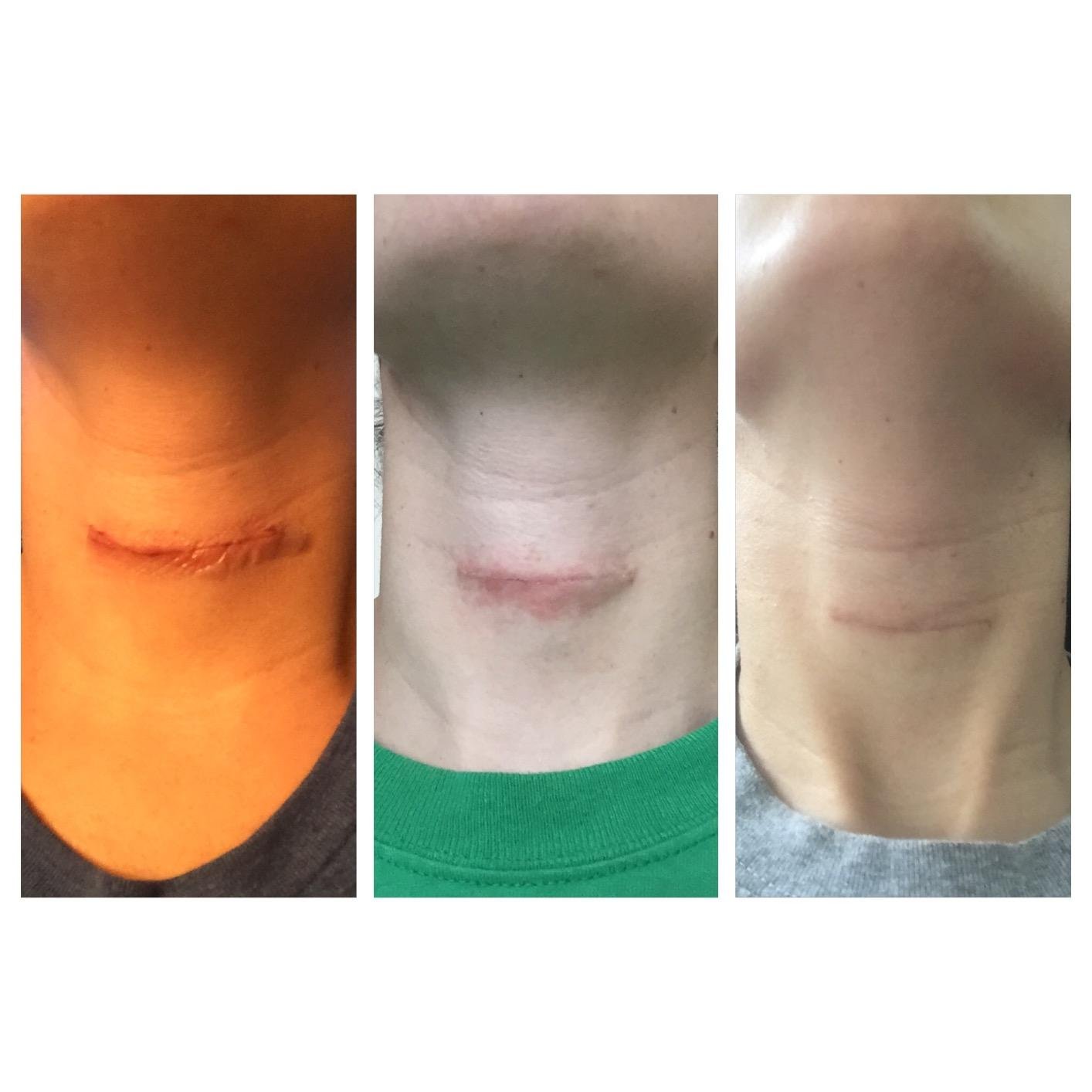  جل كريم الندبات من نيو بلس , 15 جرام 