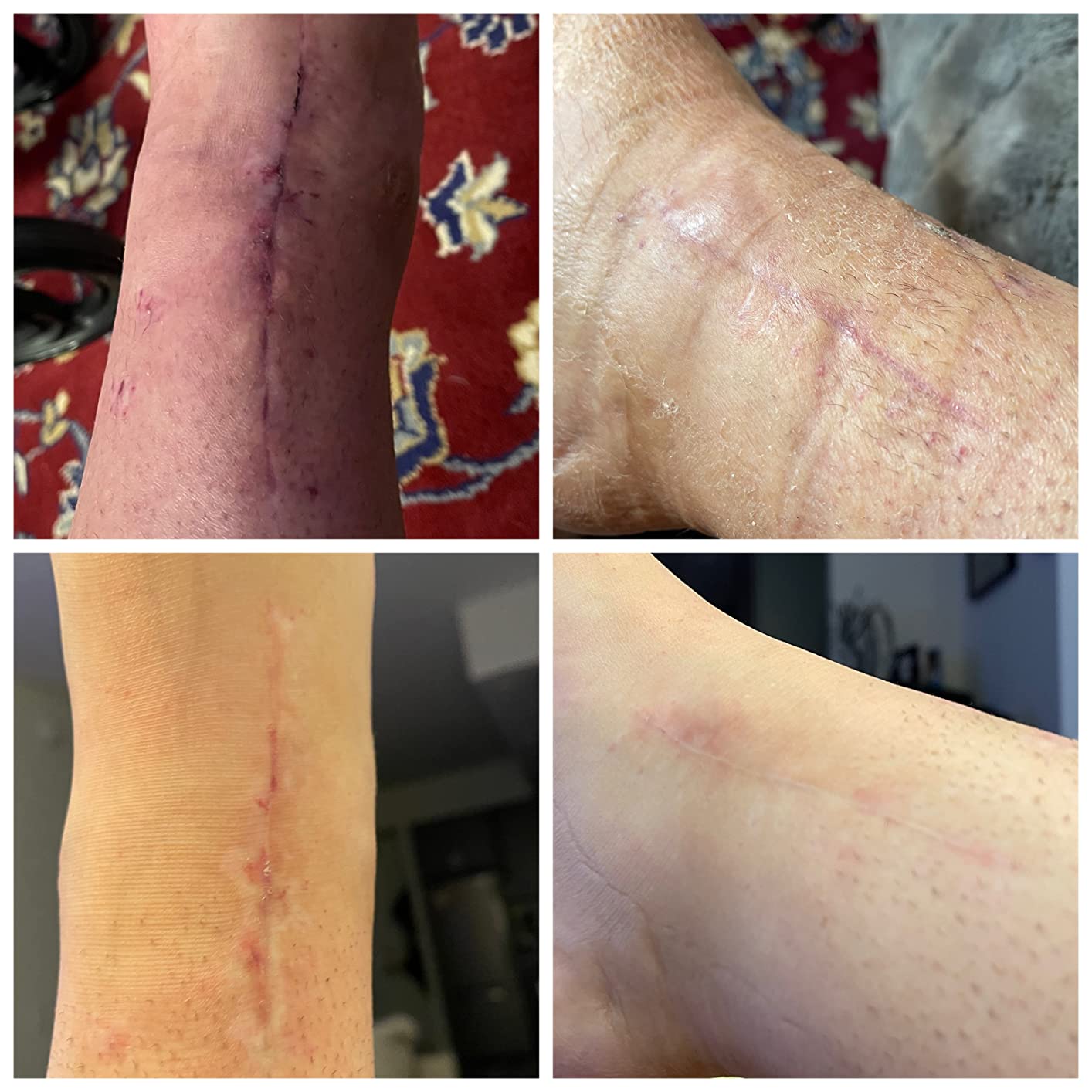  جل كريم الندبات من نيو بلس , 15 جرام 