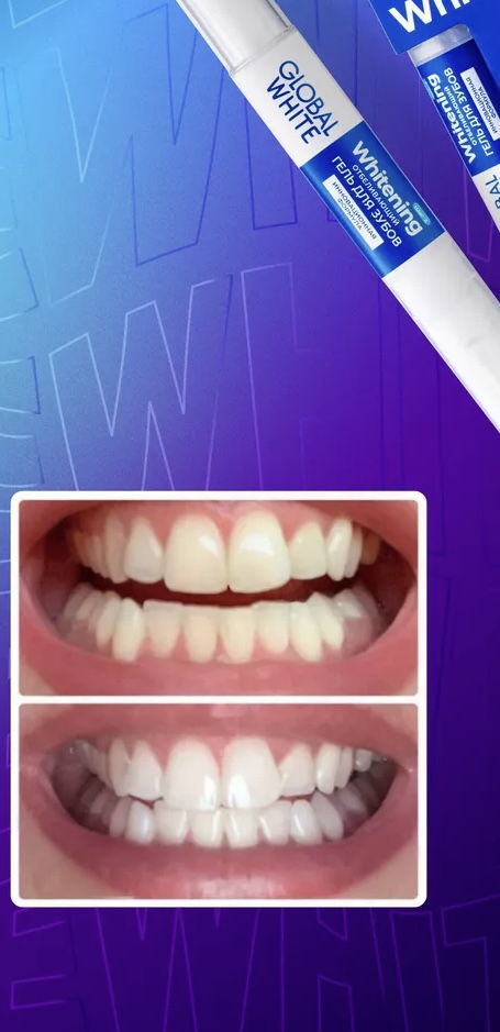  جل تبييض الأسنان Global White خمس درجات . 