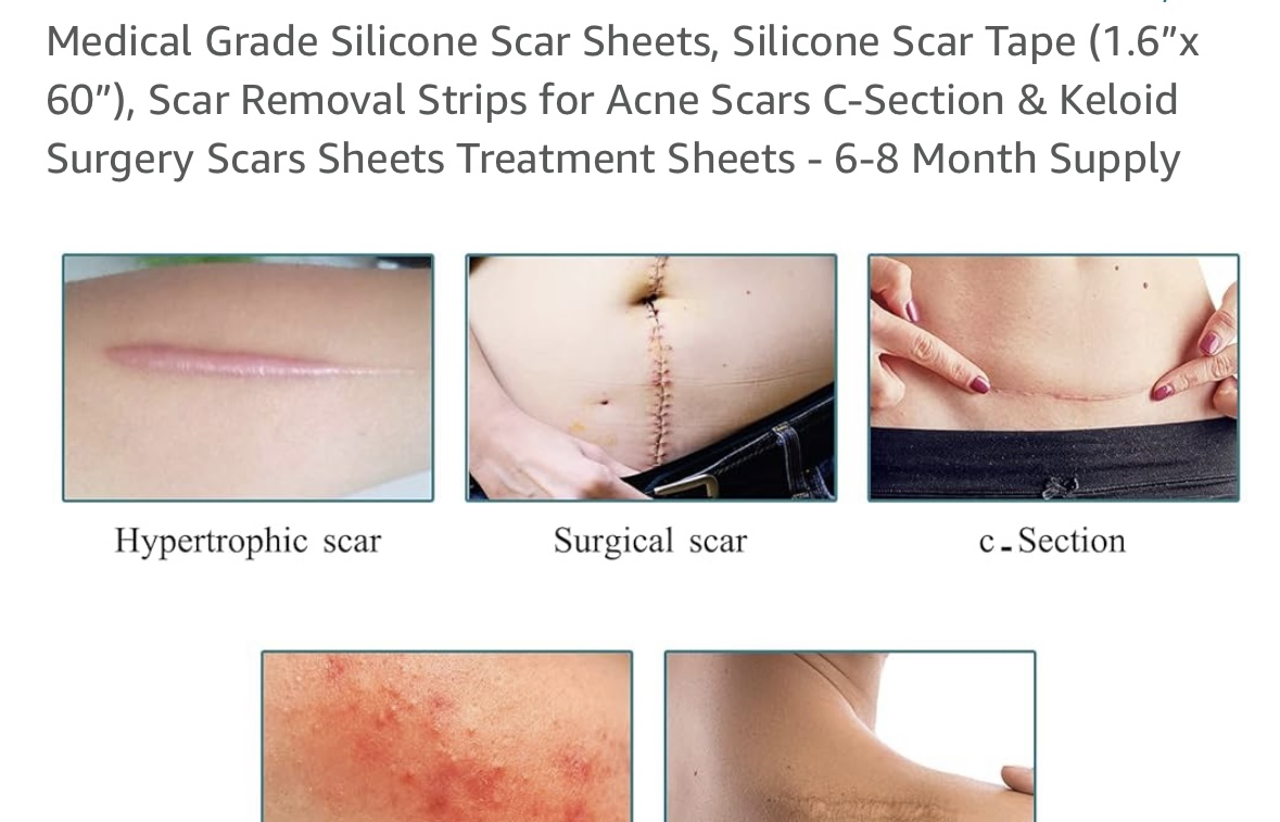  3 امتار من لصقات السيليكون Scar Away، شريط الندبات (1.6 بوصة × 120 بوصة - 4 أمتار)، شرائط الندبات، قابلة لإعادة الاستخدام، مزيل الندبات الاحترافي للعمليات القيصرية، الجراحة، الجدرة، شد البطن، رقعة الندبات، وسادات الندبات. 
