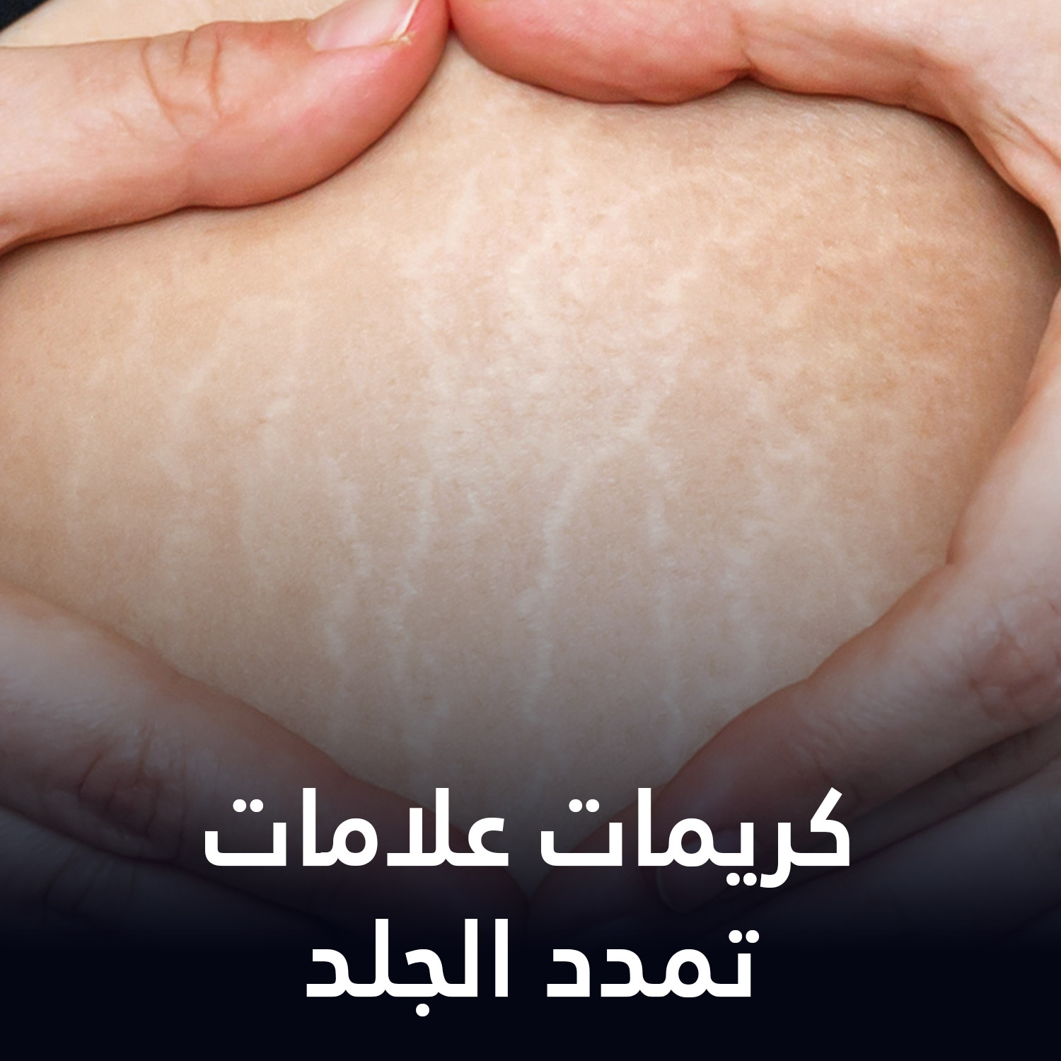 كريمات علامات تمدد الجلد