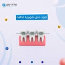 نثبيت فص تقويم 1 قطعه