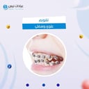 تقويم اسنان للفك الواحد حديدى