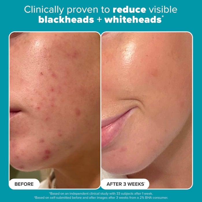 Paula's Choice  Skin Perfecting 2% BHA Liquid Exfoliating Toner for Clear Skin - Image 3