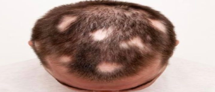 منتجات علاج الثعلبة