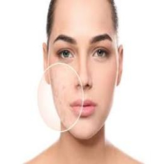 Acne & Acne Scars