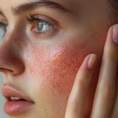 Redness & Irritation