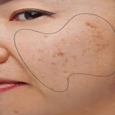 Pigmentation & Dark Spots