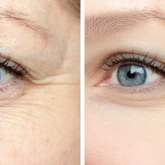 Anti Wrinkles
