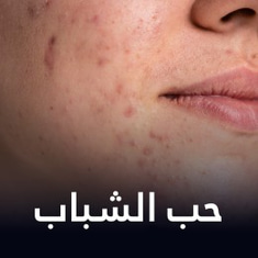 حب الشباب