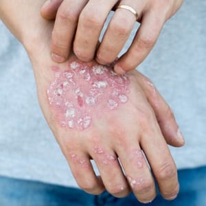 منتجات علاج الصدفية