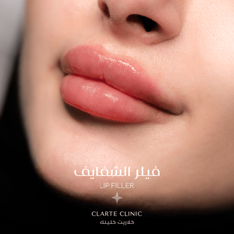 ١ مل فيلر