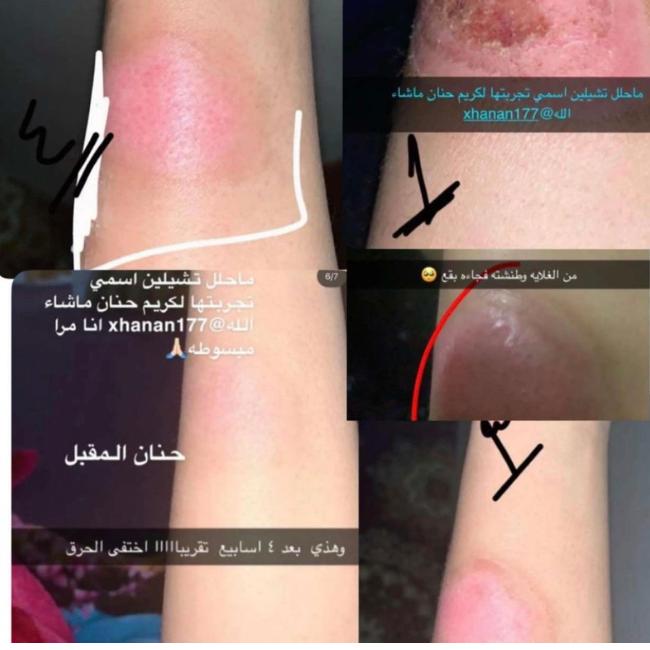 كريم حنان معالجة الحروق