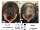 "  كورس نهلة المعالج لجميع مشاكل الشعر و الفروة (حالات العلاج قبل وبعد) صلع,ثعلبه,تساقط,قشرة وإعادة انبات_image_18