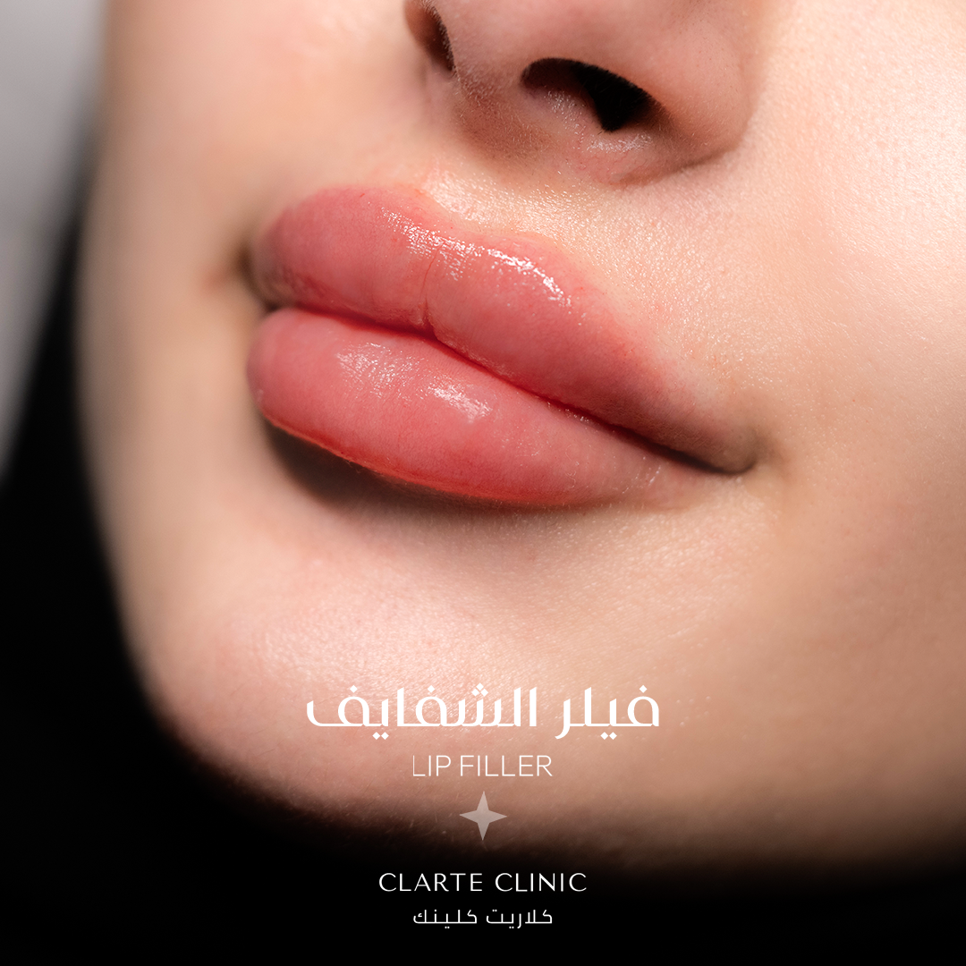  ١ مل فيلر 