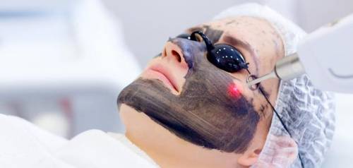 جلسة ليزر كربوني للوجه او اليدين 
