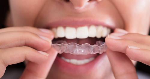 مثبت تقويم أسنان متحرك بلاستيك ( للفك الواحد )