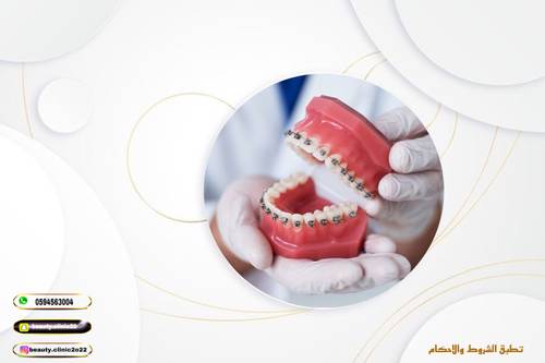 تركيب تقويم الأسنان للفكين يشمل الكشف ودراسة الحالة والاشعة البانوراما واشعة السيفالو وتركيب التقويم 