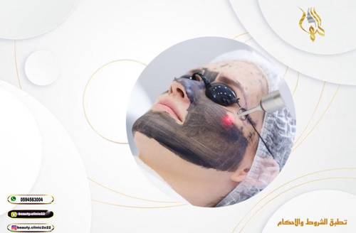 ليزر كربوني منطقة 