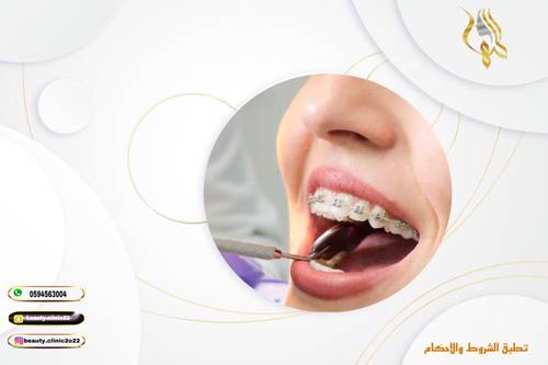 تركيب تقويم الأسنان للفك يشمل الكشف ودراسة الحالة والاشعة البانوراما واشعة السيفالو وتركيب التقويم 