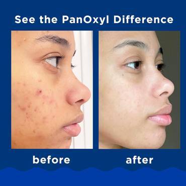 PanOxyl Acne Foaming Wash 10% Benzoyl Peroxide - 28 g