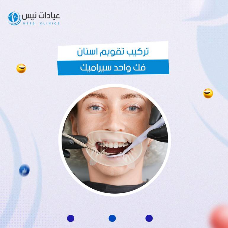 تقويم اسنان للفك الواحد سيراميك