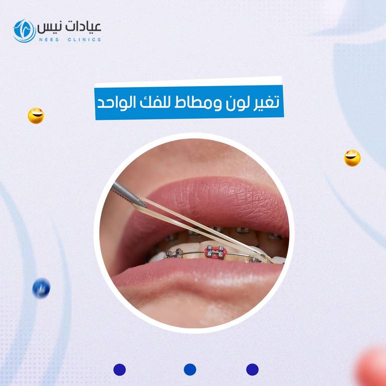 تغير لون  ومطاط للفك الواحد
