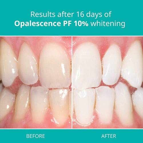 مبيض اسنان اوبالسينس 10% بالنعناع