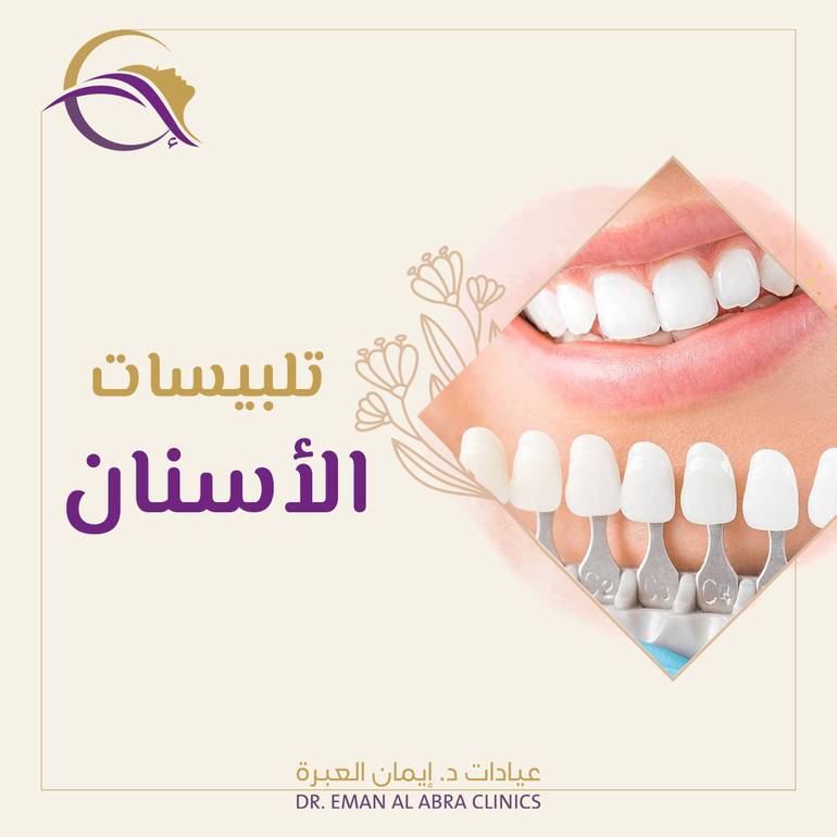 تلبيسات الأسنان 