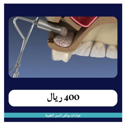 زراعة العظم للربع جرام ب 400 ريال - دفعة أولى 50 ريال 