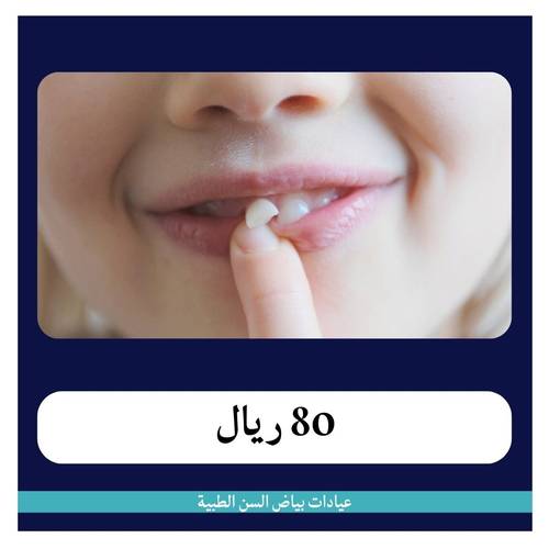 خلع سن لبني ب 80 ريال - دفعة أولى 20 ريال 
