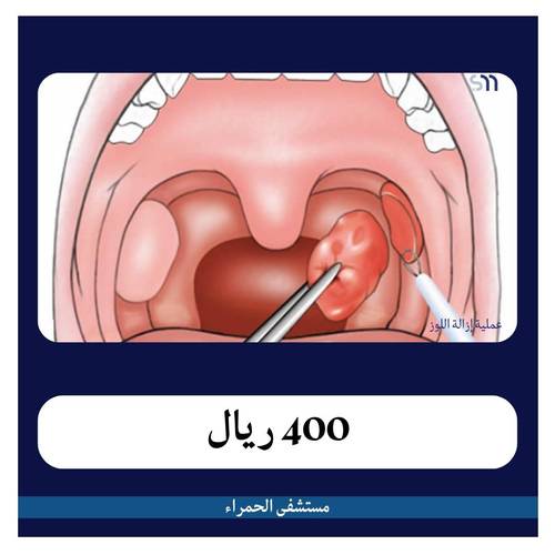 عملية إزالة اللوز بـ2600 دفعة أولى 400 ريال مستشفى الحمراء 