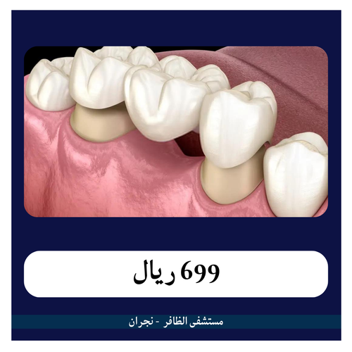 تركيبة بورسلين للسن الواحد 699 ريال - دفعة اولى 70 ريال - مستشفى الظافر