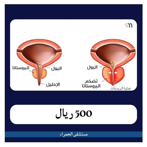 عملية البروستات بـ 12500 ريال دفعة اولى 500 ريال مستشفى الحمراء