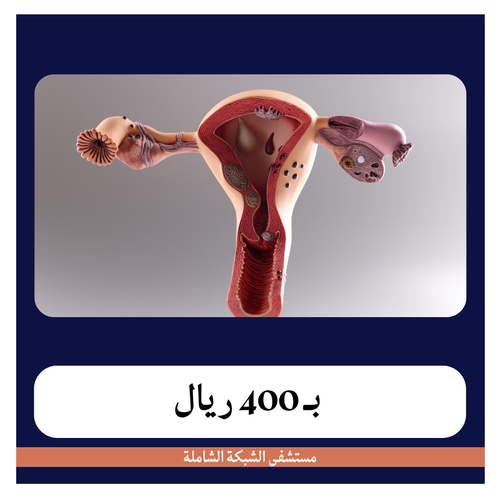 عملية إزالة أورام ليفية من الرحم بـ6400 دفعة اولى 400ريال مستشفى الشبكة الشاملة