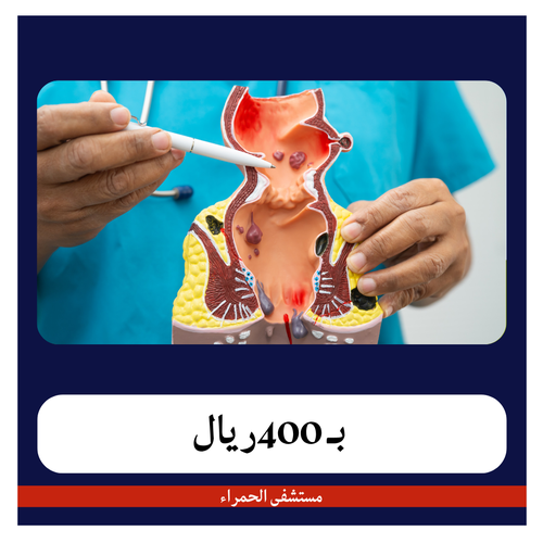 عملية البواسير بدون ألم بـ 3200 ريال دفعه اولى 400 ريال مستشفى الحمراء 