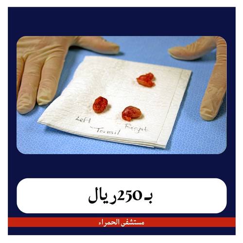 عملية إزالة اللوز واللحمية ب 3100 ريال دفعة اولى 250 ريال مستشفى الحمراء