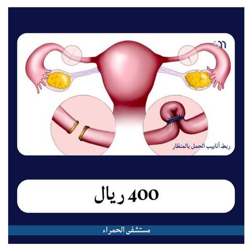 ربط الأنابيب منظار بـ4200 دفعة أولى 400 ريال مستشفى الحمراء