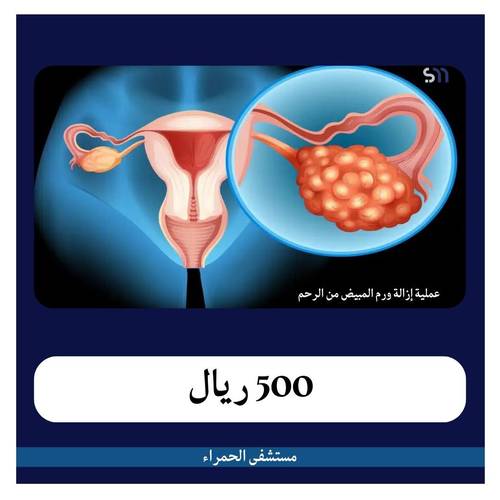 عملية إزالة ورم المبيض من الرحم بـ5300 دفعة أولى 500 ريال مستشفى الحمراء