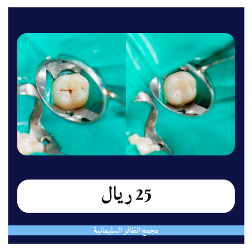 حشوة أسنان 3 أسطح 255 ريال - دفعة أولى 25 ريال مجمع الظافر الطبي 1