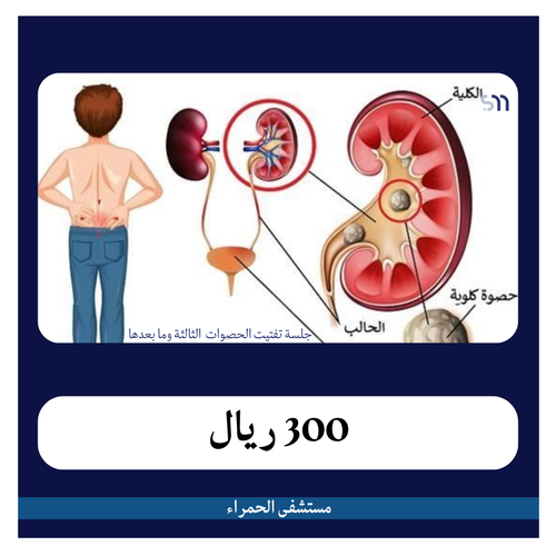 جلسه تفتيت الحصوات للمرة الثالثة ومابعدها بـ 750ريال دفعة اولى 300 ريال  مجمع العزيزية