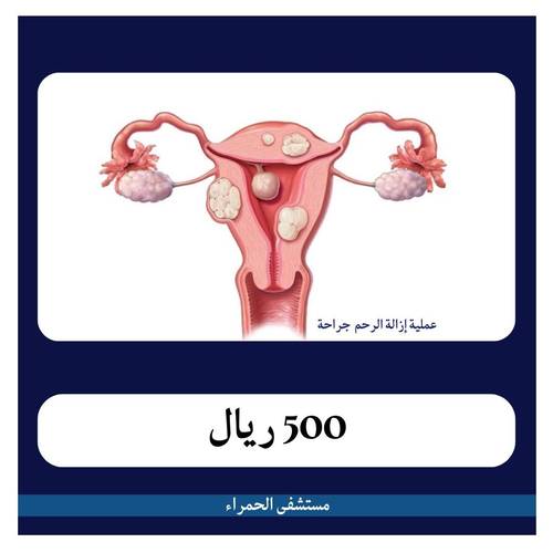 عملية إزالة الرحم جراحة بـ6000 ريال دفعة أولى 500 ريال مستشفى الحمراء