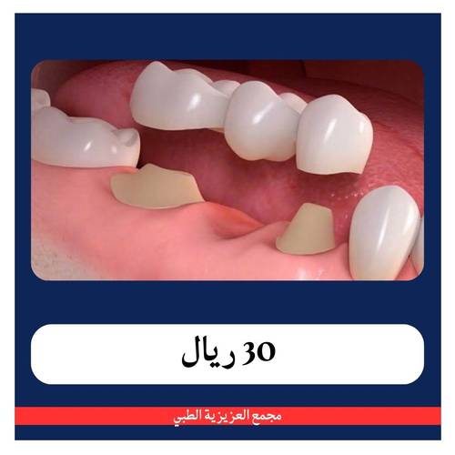 علاج عصب لسن امامي ب 180 ريال - دفعة أولى 30 ريال - مجمع العزيزية 