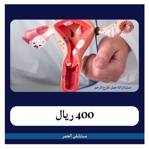 عملية إزالة حمل خارج الرحم بـ7500 دفعة أولى 400 ريال مستشفى الحمراء