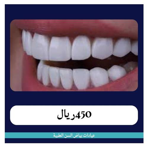    سن زيركون عادي ب 450 ريال - دفعة أولى 50 ريال 