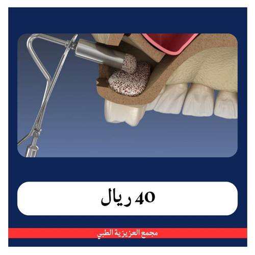 علاج عصب لسن خلفي مع اشعة + كشفية و خطة علاجية بـ 290 ريال  - دفعة اولى 40 ريال - مجمع العزيزية