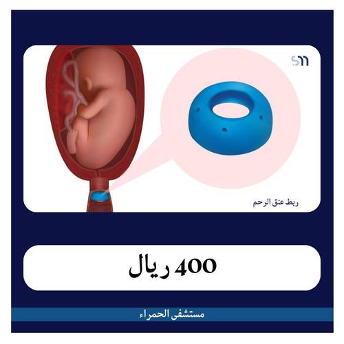 ربط عنق الرحم بـ 2600 دفعة أولى 400 ريال مستشفى الحمراء